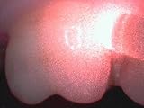 Light Therapy Dental Treatment