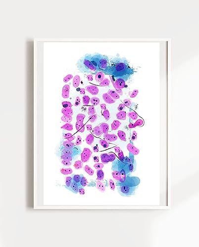 Urology Art, Pathology Poster, Prostatic Adenocarcinoma, Urology Decorations for Doctor, Pathology Wall Art Assistant Gift, Fine Art Print (11.7x16.5 in (A3))